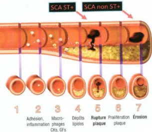 Figure 1 : Evolution de la maladie athéromateuse 