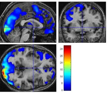 Figure 2.8: Example of thresholded F-map. Axial, coronal and sagittal views of a thresholded F-map (colour-coded F-values, p < 0.05, corrected for multiple comparisons), overlaid over a single subject anatomical image.