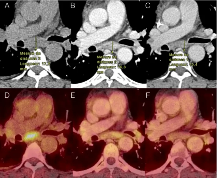 Fig. 7 : Discordance morphologique et métabolique : A-D : TEP de baseline ; B-E : TEP  d’évaluation 1 à 7 semaines de traitement ; C-F : TEP d’évaluation 2 à 3 mois