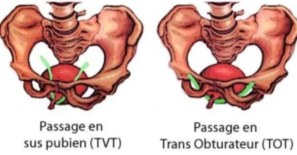 Figure 4  : TVT et TOT (Source : incontinence urinaire d’effort chez la femme, CH libourne)    