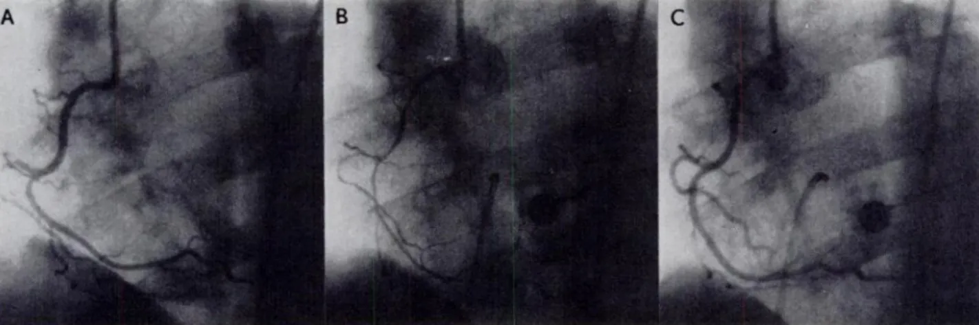 Table 5-Angiographic Findings*