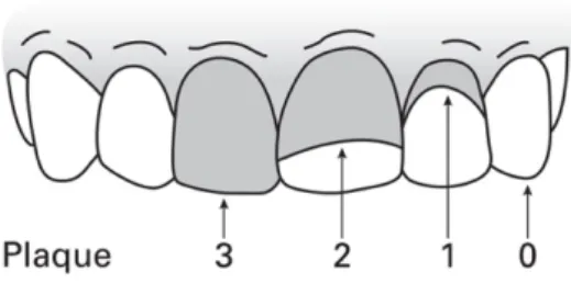 Figure 4: Indice de tartre et plaque dentaire, OHIS  (Source : http://monde.ccdmd.qc.ca/ressource/?id=5)