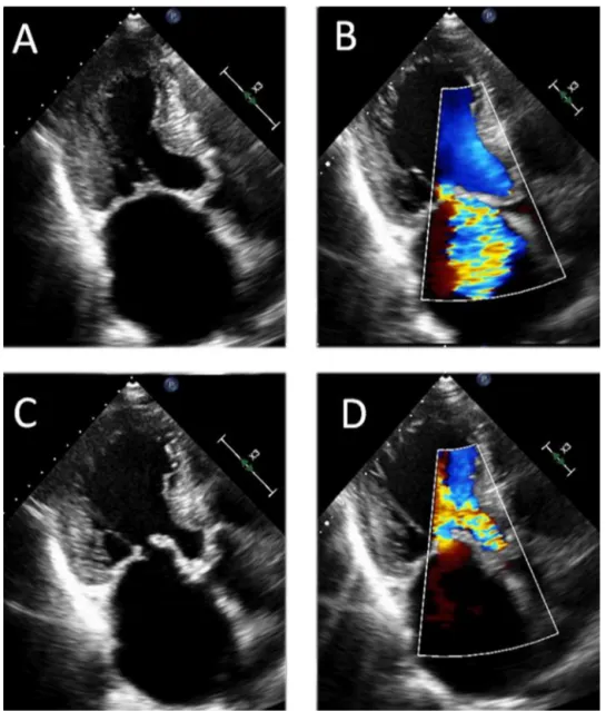Figure 1. Combined rheumatic aortic and mitral regurgitation. A and B. Systolic still frames