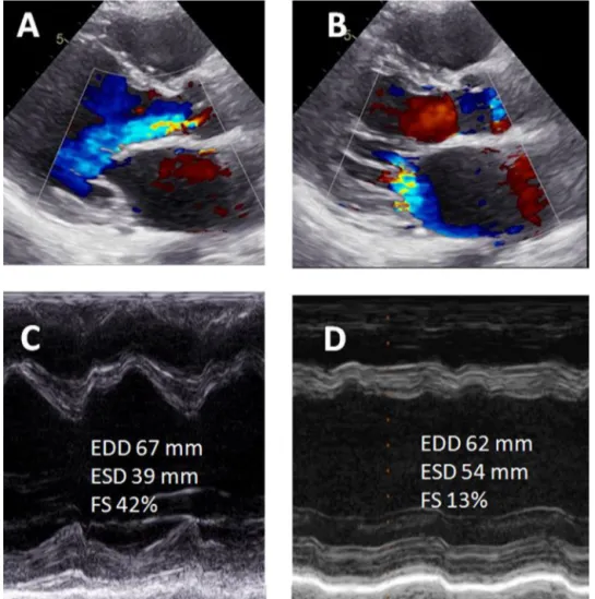 Figure 5. A. and B. Diastolic and systolic parasternal long-axis views showing severe AR and moderate-to-severe MR, respectively