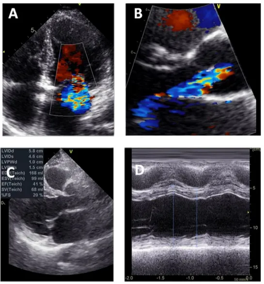 Figure 7. A and B. Rheumatic heart disease, including moderate mitral regurgitation (mitral effective regurgitant oriﬁce 0.25 cm 2 ; A) and moderate aortic regurgitation (vena contracta 5 mm; B)