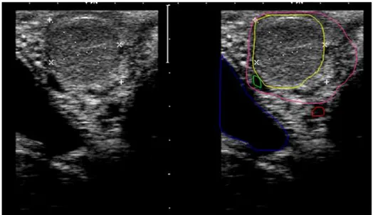 Figure 10 : image échographique d’une endométrite  chronique (la ligne bleue identifie les contours  de la paroi utérine et la ligne rouge le contour de la cavité utérine en étoile) 