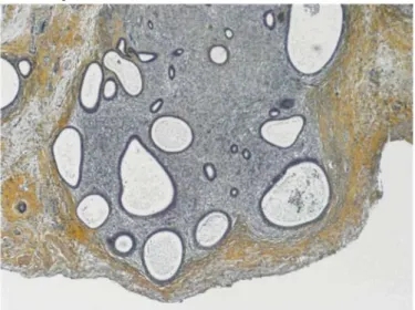 Fig. 1. Développement d'une lésion d'endométriose suite à la transplantation d'endomètre humain chez la souris  SCID