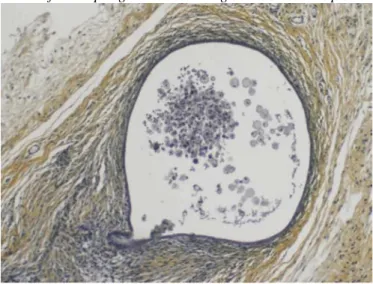 Fig. 2. Développement d'une lésion d'endométriose suite à la transplantation d'endomètre humain chez la souris  nue
