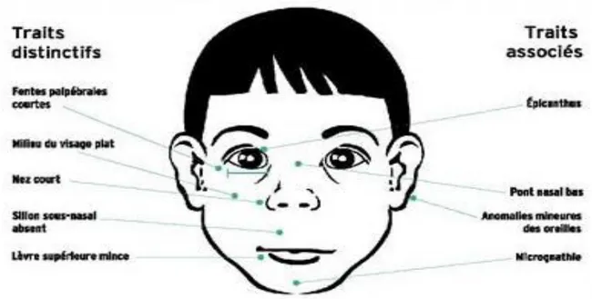 Figure 3 : Traits caractéristiques de la dysmorphie cranio-faciale chez un enfant porteur  de SAF