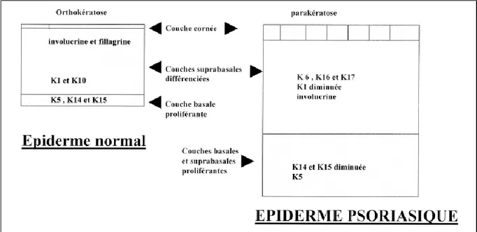 Figure 11 : Schéma des modifications observées dans l’épiderme psoriasique : extension du  compartiment germinatif et altérations (36) 