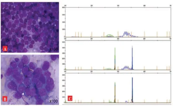 Figure 5 Transformation d’une leucémie lymphoïde chronique en LBDGC 
