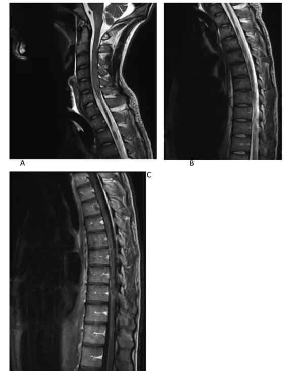 Figure 2. A—B. IRM de la moelle dorsale en pondération T2 TSE montre des lésions intramédullaire en hyperintensités diffuses avec une atrophie de la moelle cervico-dorsale