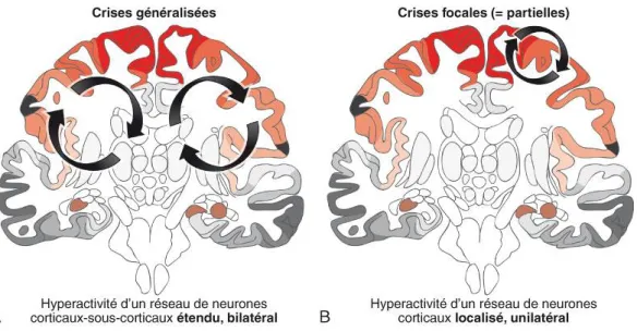 Figure 2 : Les crises épileptiques sont dites « généralisées » ou « focales »