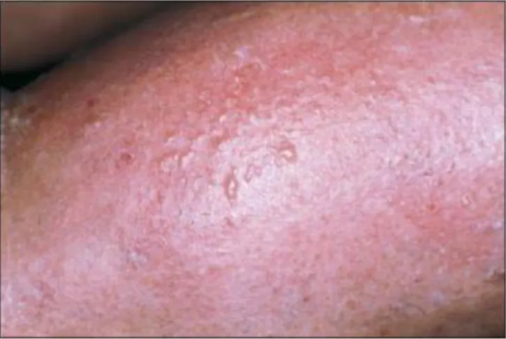 Figure 2a : eczéma en phase vésiculeuse. [b] 