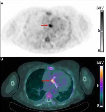 Fig. 1. PET/CT au FDG révélant un foyer intensément hypermétabolique (pointé  par la flèche rouge) intéressant le versant mitral de la valve aortique et le versant  aortique de la valve mitrale ainsi que la continuité mitro-aortique.