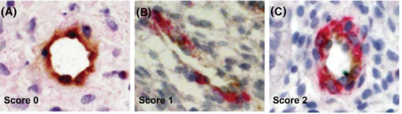 Figure 1: Illustration of αSMA immunostaining scoring. αSMA positive cells were labelled in red and 