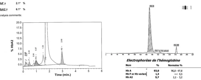 Figure 10:Exemple de chromatogramme (Variant ®  II) et électrophorégramme (Capillarys ® 2) d’un patient adulte  porteur d’une bêta thalassémie mineure 
