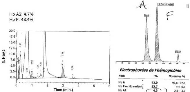 Figure 11:Exemple de chromatogramme (Variant ®  II) et électrophorégramme (Capillarys ® 2) d’un patient adulte  atteint de  bêta thalassémie majeure/intermédiaire (β+) 