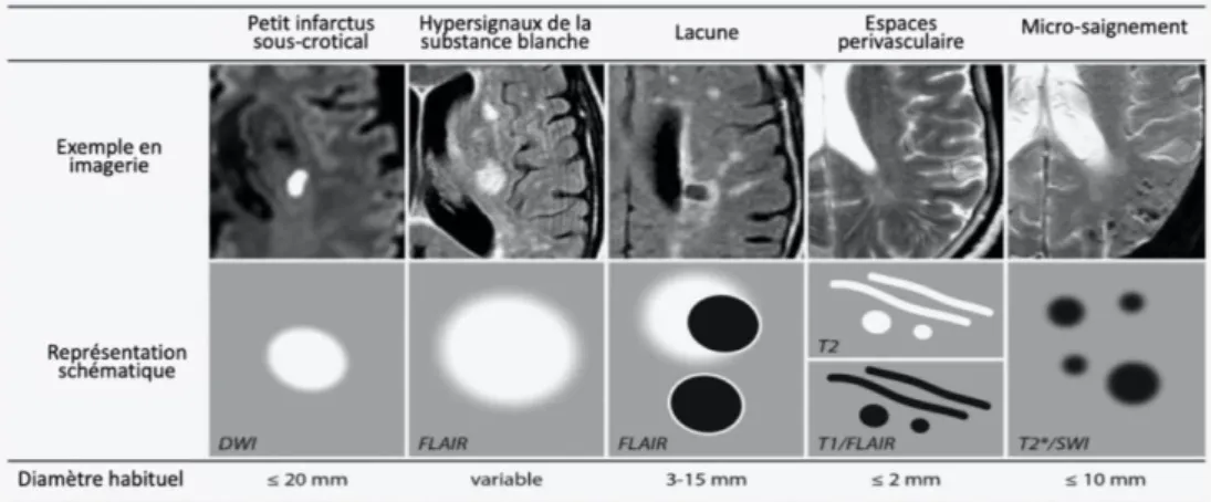 Figure 9: Exemple d'images et représentation schématique des différents changement structuraux associés à une maladie des  petits vaisseaux cérébraux (source : Adapté et traduit en français de Shi, Y