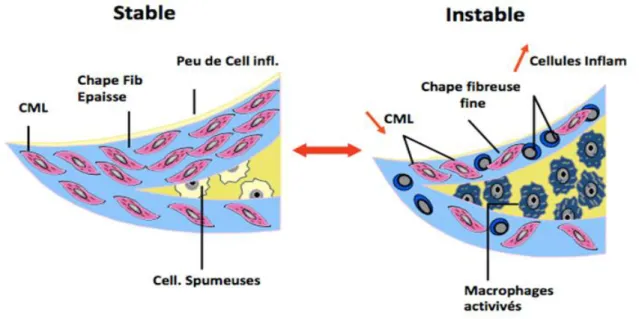Figure 15: Comparatif plaque stable vs plaque instable 2 