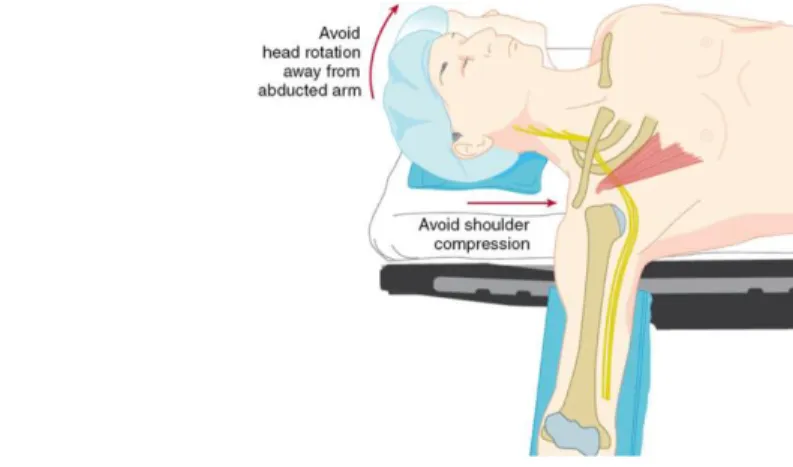 Figure 5 : Compression du Plexus Brachial dans la position de décubitus dorsal