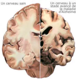 Figure 5- coupe transversale d'un cerveau normal contre un individu Alzheimer ((15)                          