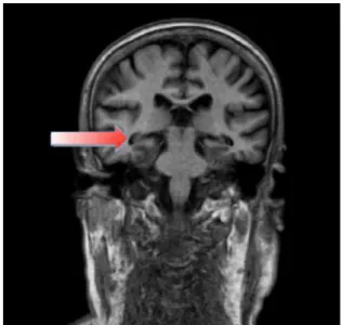 Figure 7 - IRM (coupe coronaire) montrant une atrophie de l'hippocampe                                                                                                   chez patient atteint de la maladie d’Alzheimer (31) 