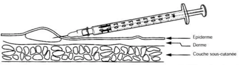 Figure 3 : Injection intradermique 