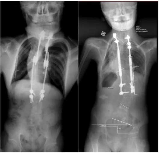 Figure 15 : Radiographies de différents montages doubles de tiges de croissance (Tiges de  Croissance Standard à gauche et Tiges de Croissance Electromagnétiques à droite) 