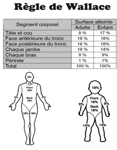 Figure 4 : Surface corporelle impactée par les brûlures «Règle de Wallace» 
