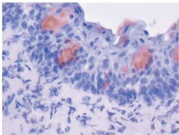 Figure 8 - Biopsie conjonctivale, en rouge les cellules caliciformes (marquage anticorps anti- anti-MUC (Mucines)[12]) 