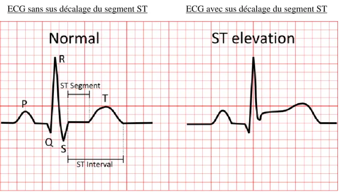 Figure 4 : Schéma d’un ECG lors d’un SCA (37) 