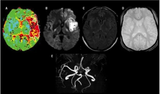 Figure 8 : IRM cérébrale d’une occlusion de l’artère sylvienne gauche [38]. 