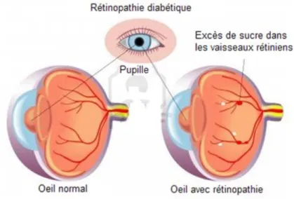 Figure 4: La rétinopathie diabétique