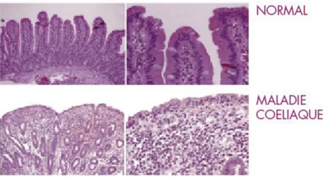 Figure 15 : Villosités intestinales chez un sujet sain versus atrophie villositaire  dans le cas de la maladie cœliaque  (37) 