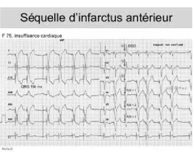 Figure n°4 présentant un électrocardiogramme avec séquelle d’infarctus
