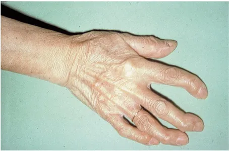 Figure 12 : Forme clinique d’arthrose interphalangienne distale 