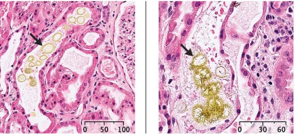 Figure  11  :  Cristaux  de  méthotrexate  observés  au  microscope  sur  des  coupes  de  tubule  rénal  colorées  à  l'hématoxyline- l'hématoxyline-éosine