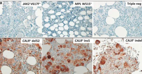 Figure 11 : Marquage immunohistochimique des protéines CALR mutées sur biopsies de moelle  osseuse