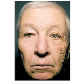 Figure 15 : Effet des rayonnements UV sur la peau. Un chauffeur de camion de 69ans ayant été sur-exposé  pendant 25 ans du même côté du visage lors de sa conduite