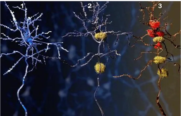 Figure 5: 3 phases d'évolution d'un neurone atteint de la M