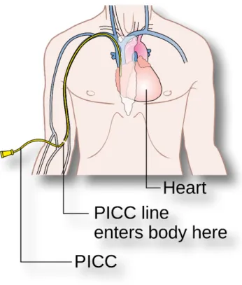 Figure 1: Schéma du parcours du PICC Line au sein du réseau veineux jusqu'à la jonction  atrio-ventriculaire