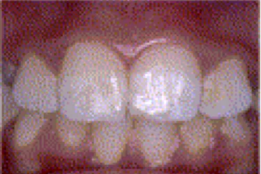 Figure 10 : Dyschromie intrinsèque (Fluorose dentaire) (37). 