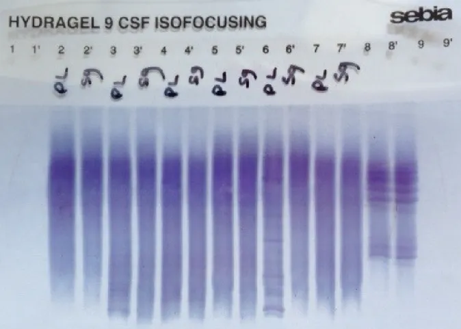 Figure 5 - Analyse comparée en IEF de 6 couples LCR/sérum (et un contrôle positif en  positions 8 et 8’) par technique Hydragel 9CSF   Isofocusing   Sebia (image laboratoire 