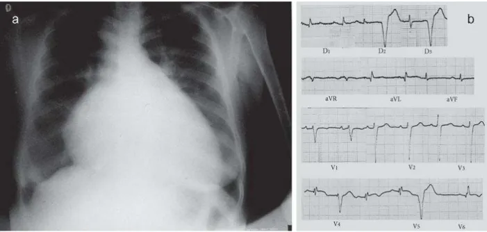 Figure 1-13 -  Cardiomégalie et ECG révélateur d’une cardiomyopathie  chagasique  (15)