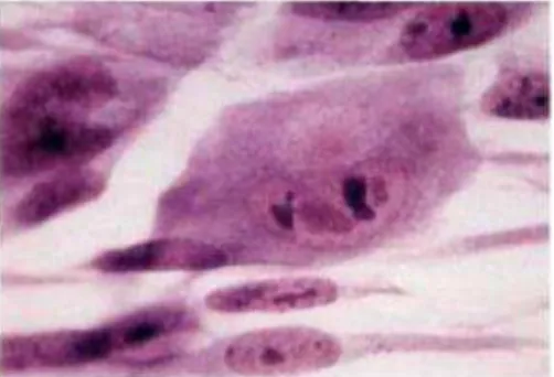 Figure 6 : Effet cytopathique du Cytomégalovirus sur une coupe tissulaire  (Huraux, 2003) 