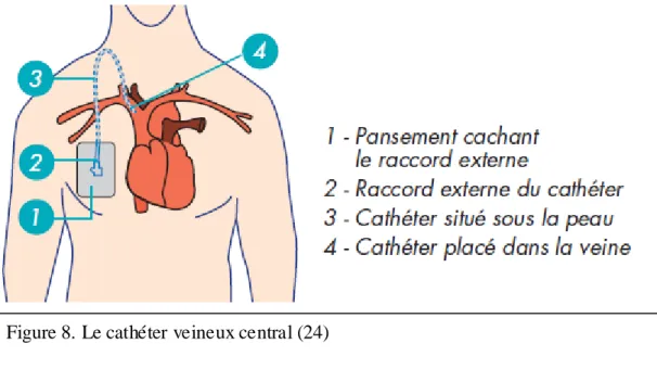 Figure 8. Le cathéter veineux central (24) 