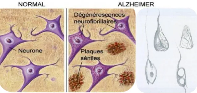 Figure 5 : Représentation des dégénérescences neurofibrillaires. (d’après  www.ahaf.org/alzheimers et dessin original d’Alois Alzheimer)