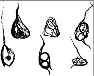 Figure 2 : Des dégénérescences neurofibrillaires dessinées par Alois Alzheimer     (Ramirez-Bermudez, 2012) 