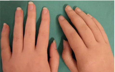 Figure 2: Troubles trophiques de l’AD :  Contraste entre une main souffrant d’AD (droite) et la main saine  controlatérale (gauche) présentant des changements trophiques